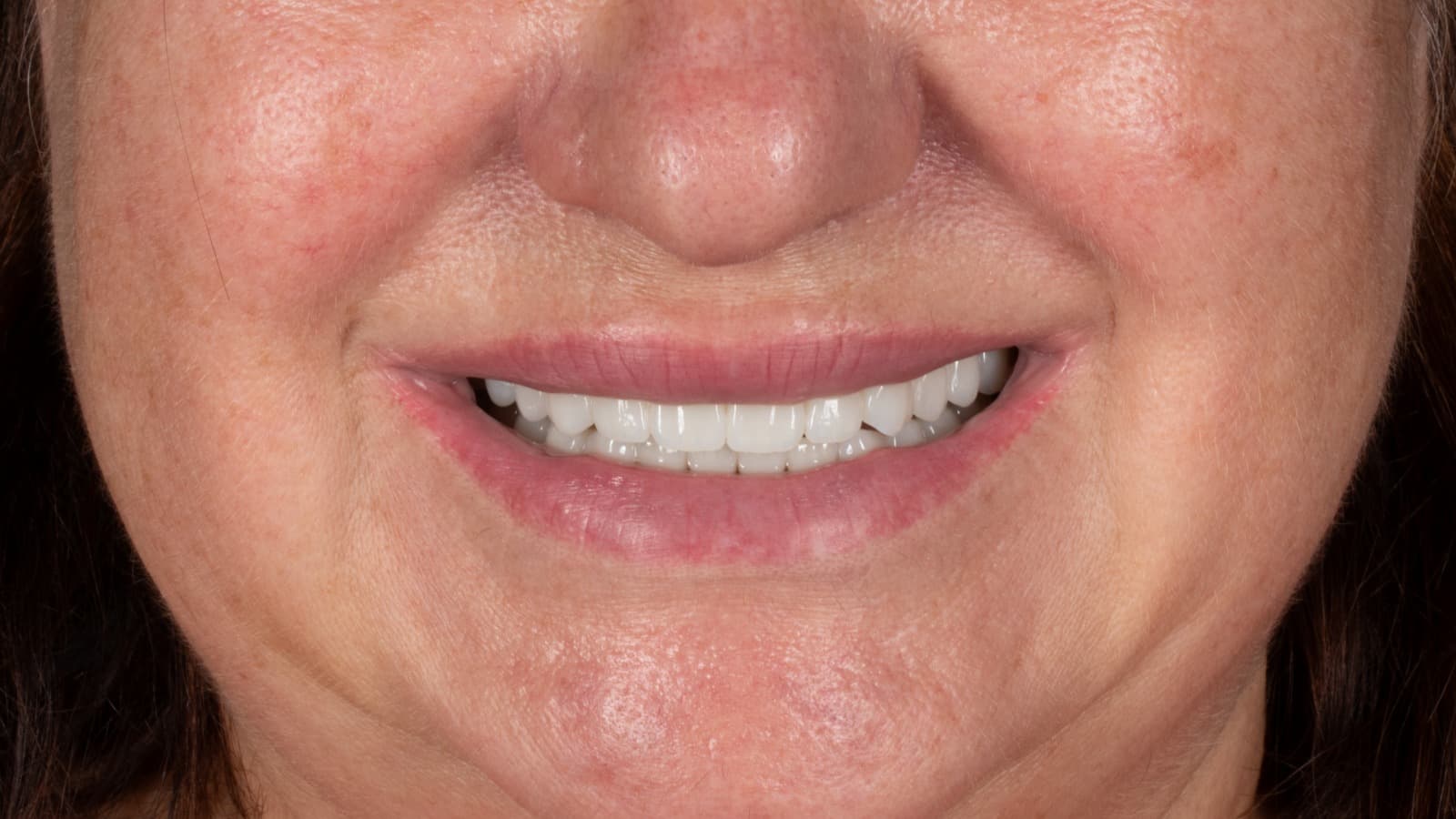 Case Study | Helen